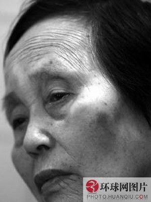 桑拿女被男友虐待48小時 乳頭被燙傷腳底皮被烤熟（組圖）