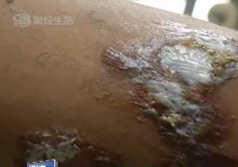 桑拿女被男友虐待48小時