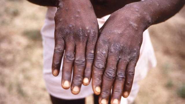 WHO：猴痘可能已經暗中傳播了數月或數年(圖:AFP)