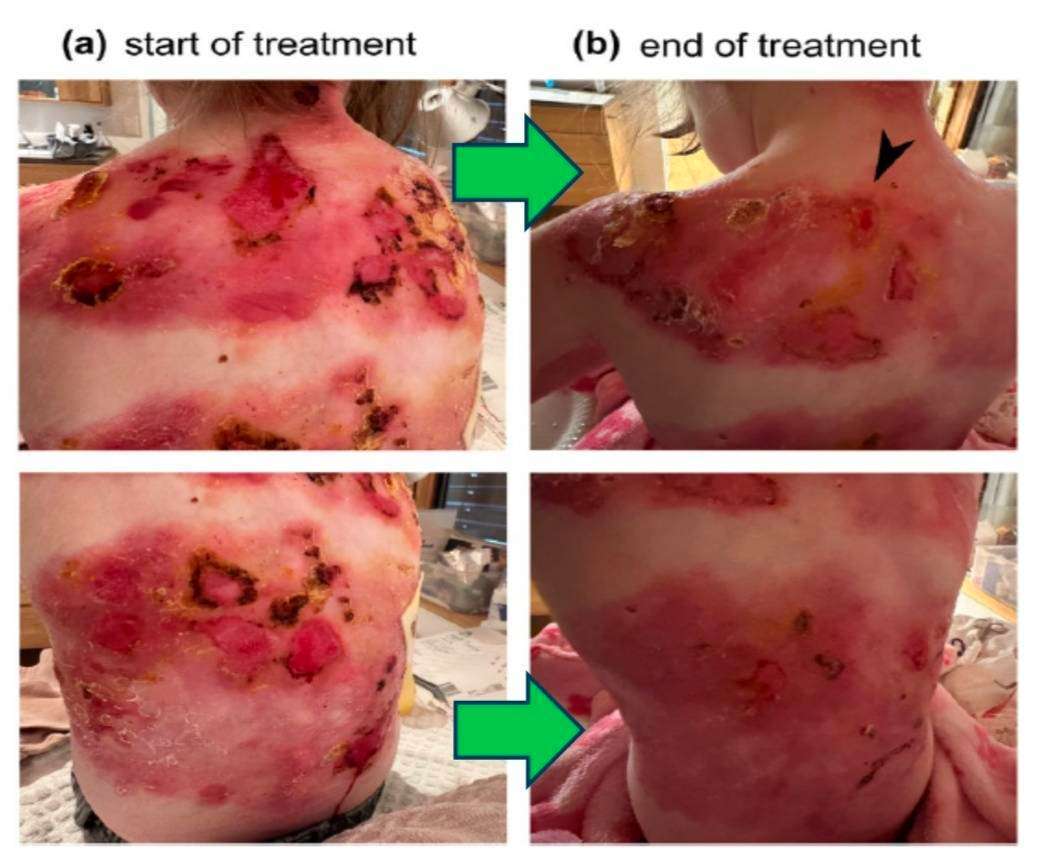 「失養型遺傳性表皮分解性水皰症」病患接受 1% diacerein （AC-203 之活性成分）乳膏治療28天，慢性傷口有明顯癒合，截自The Journal of Dermatology, 2025